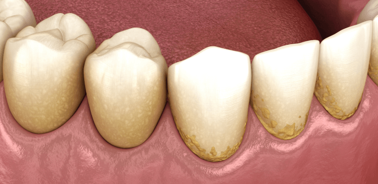 Cambios asocados con gingivitis
